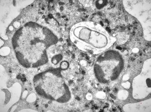 M,2w. | bacteriaemia - phagocytosed microbes